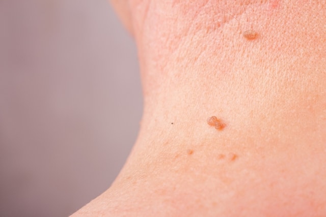 papilloma virus viso îndepărtarea papiloamelor pe piele