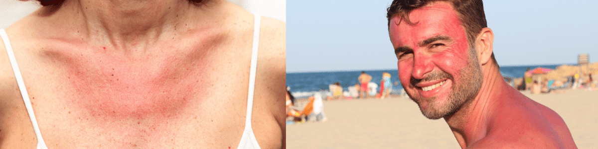 Cu varicele la plajă: ce trebuie să faci pentru a te proteja