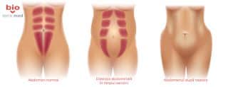 Diastaza abdominala