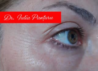 Blefaroplastie fara bisturiu - Dr. Iulia Panturu