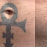 Indepartarea tatuajelor cu laser