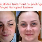 Peelingul-chimic-Target-Nanopeel-System-pentru-melasma-si-pete-pigmentare