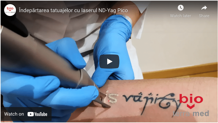 Îndepărtarea tatuajelor, video